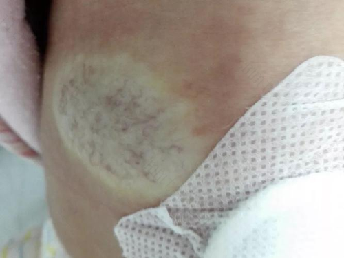 秋季宝宝肚脐血管瘤要怎么护理？