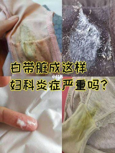 白带变黑是怎么回事？比“雾霾”更可怕