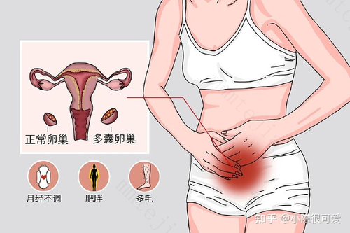 粗犷型女汉子的苦恼，多囊卵巢综合征的危害