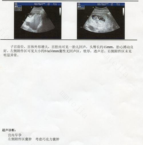 巧克力囊肿影响怀孕吗
