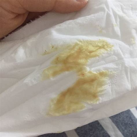 白带发黄外阴发痒是怎么回事