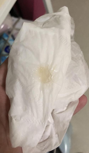 排卵期有哪些症状？白带会出现拉丝