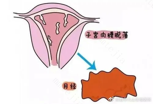 子宫内膜增生是癌吗