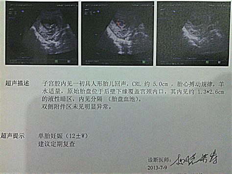 宫颈检查有出血状况正常吗