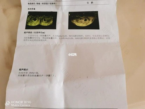 想生双胞胎 关键要知道这些事
