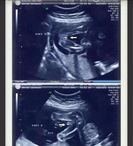 民间看胎儿男女方法是否有用呢?这些告诉你真相! 民间看胎儿男女方法是否有用呢?这些告诉你真相!