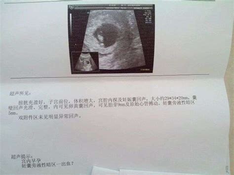 怎么判断胎儿性别