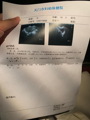 没有卵泡可以怀孕吗 没有卵泡可以怀孕吗