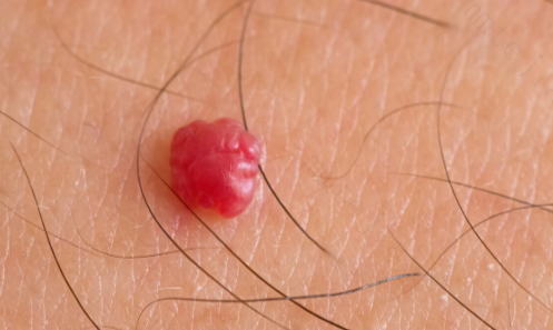 女人私处长痘痘是怎么回事 这种小痘痘一定要警惕! 女人私处长痘痘是怎么回事 这种小痘痘一定要警惕!