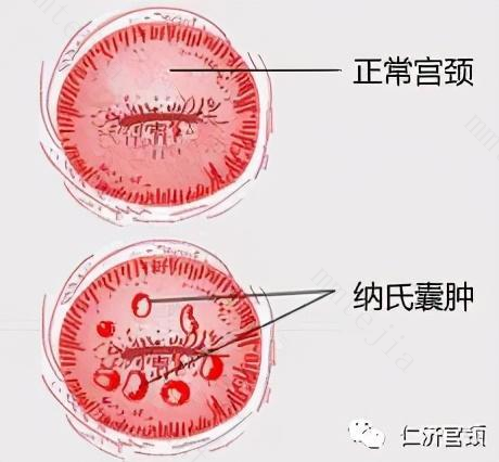 痛经和宫颈囊肿有关系吗 宫颈囊肿有哪些症状表现
