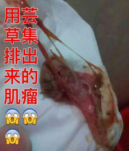 巧克力囊肿破裂怎么办