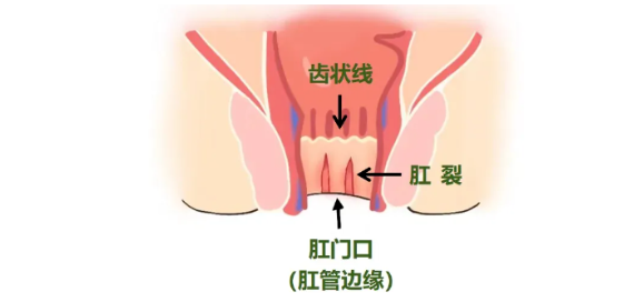 比会阴侧切还要命的肛裂，产前预防+产后康复的秘诀来了！