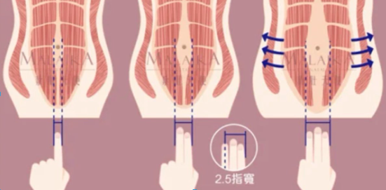 3 步自测腹直肌是否分离，附修复全方案！