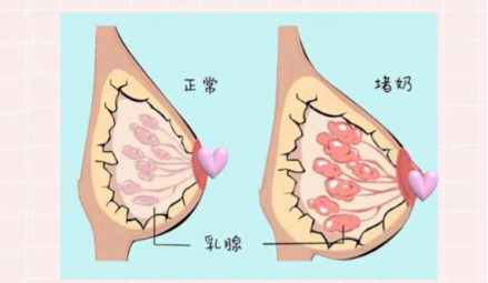 4 个 “致命误区”，哺乳期堵奶时坚决别碰，90%产后妈妈都