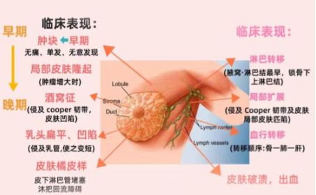 有乳腺癌家族史的高危人群怎么办?超详细的早筛时间表 + 防护