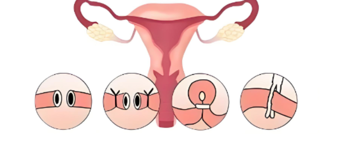 “下面”变短了？切完子宫，同房时最怕的三个问题，一次说清