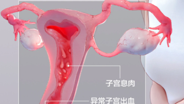 子宫息肉 = 癌前病变？备孕党必看：切不切，看这几点就够了！