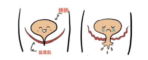 盆底肌不是越紧越好!90% 妈妈都练错了,越练越伤 。