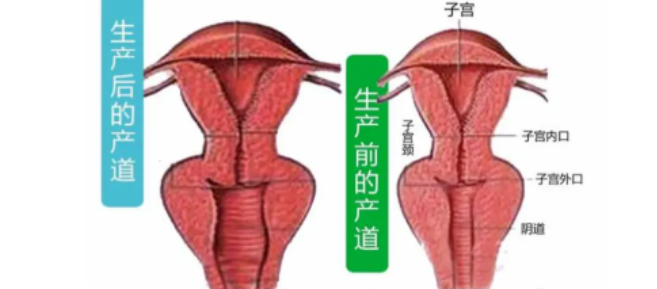 产后阴道口闭合不全，细菌长驱直入？每天3分钟“关门操”，比洗