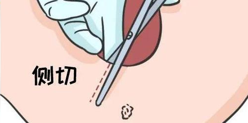 顺产侧切/撕裂缝合后，“肉芽”增生、线头不吸收？这样做避免二