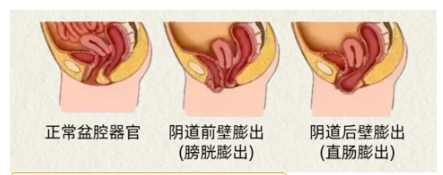 子宫脱垂、膀胱膨出别硬扛!教你镜子法自测盆底脱垂!