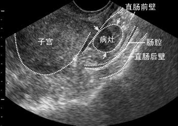 痛经和宫颈囊肿有关系吗 宫颈囊肿有哪些症状表现 痛经和宫颈囊肿有关系吗